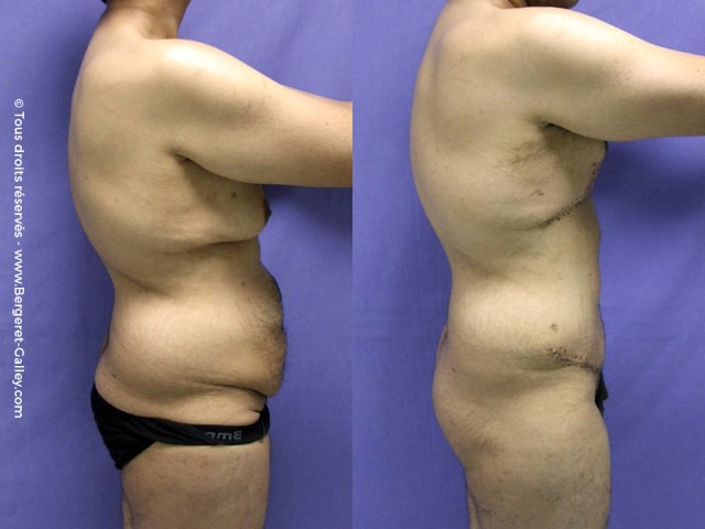 Bodylift, cas 7, photographie avant et après