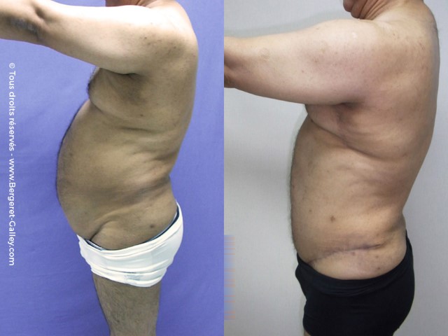 Bodylift, cas 8, photographie avant et après