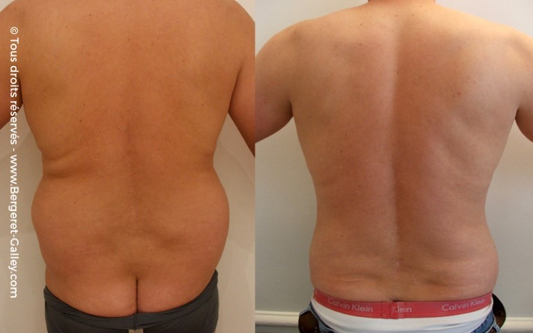 Liposuccion, cas 1, photographie avant et après