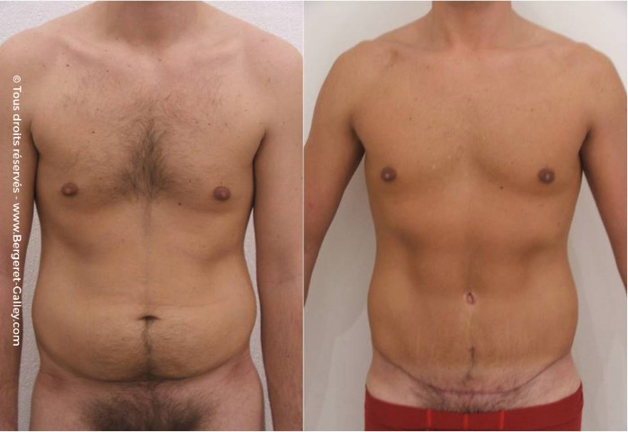 Liposuccion, cas 2, photographie avant et après