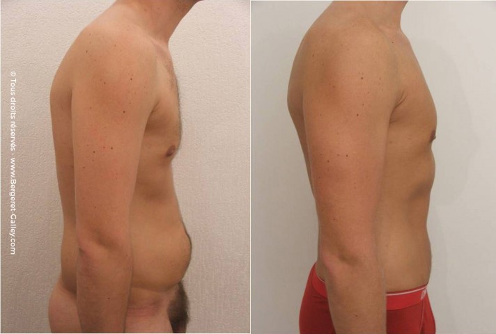 Liposuccion, cas 3, photographie avant et après