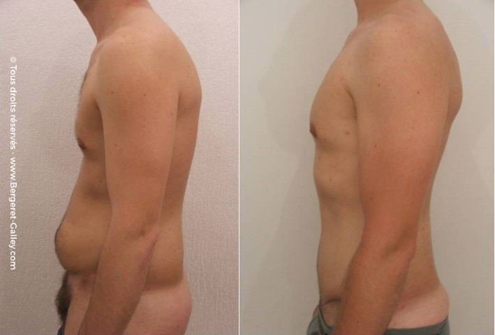 Liposuccion, cas 4, photographie avant et après