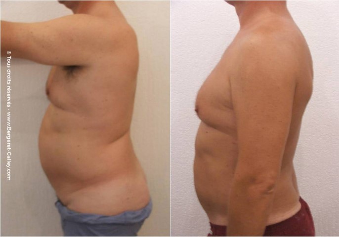 Liposuccion, cas 6, photographie avant et après