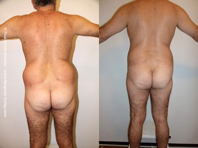 Liposuccion, cas 7, photographie avant et après