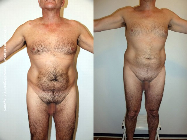 Liposuccion, cas 8, photographie avant et après