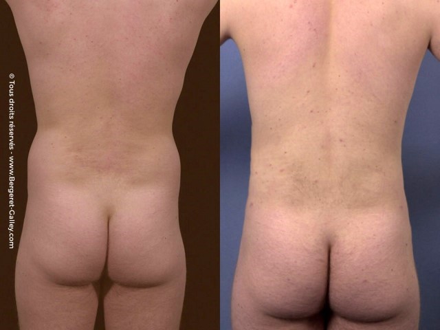 Liposuccion, cas 10, photographie avant et après