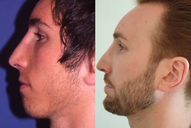 Masculinisation du visage, cas 1, photographie avant et après
