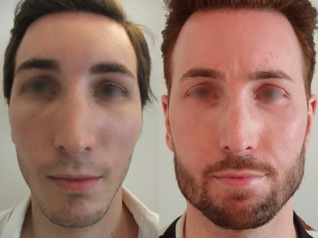 Masculinisation du visage, cas 2, photographie avant et après