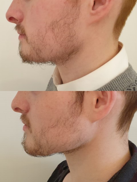 Masculinisation du visage, cas 3, photographie avant et après