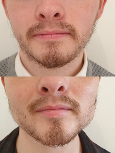Masculinisation du visage, cas 4, photographie avant et après