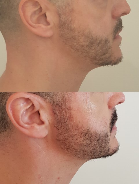 Masculinisation du visage, cas 5, photographie avant et après