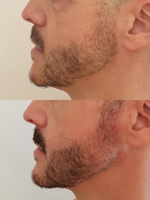 Masculinisation du visage, cas 6, photographie avant et après