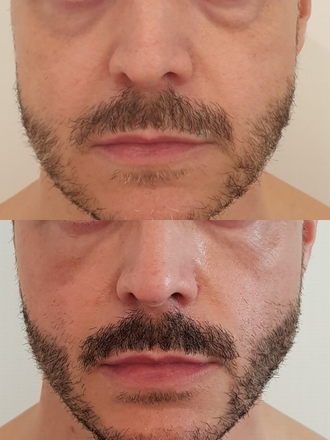 Masculinisation du visage, cas 7, photographie avant et après