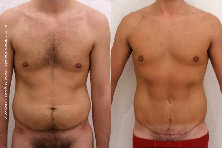 Plastie abdominale, cas 1, photographie avant et après