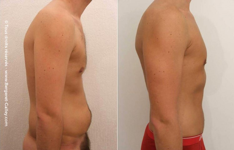 Plastie abdominale, cas 2, photographie avant et après