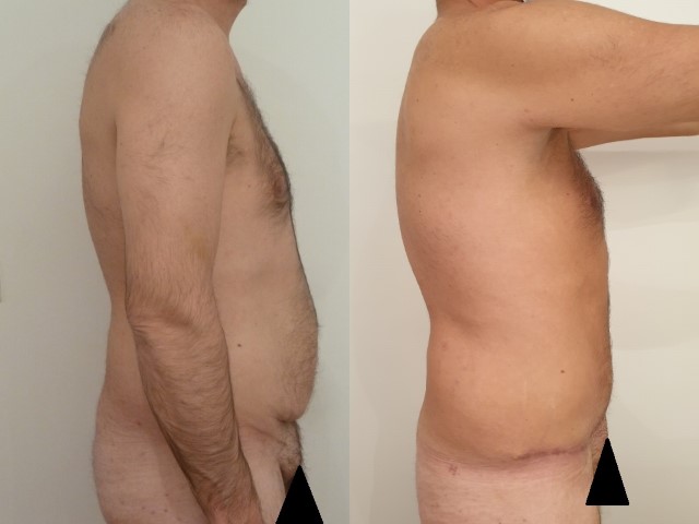 Plastie abdominale, cas 4, photographie avant et après