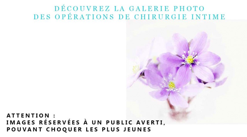 Nymphoplastie, cas 1, photographie avant et après