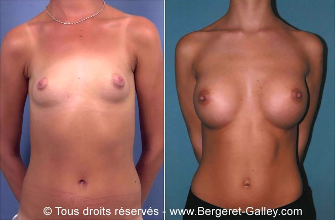 Augmentation mammaire par prothèse, cas 1, photographie avant et après