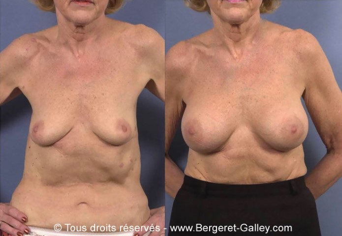 Augmentation mammaire par prothèse, cas 3, photographie avant et après