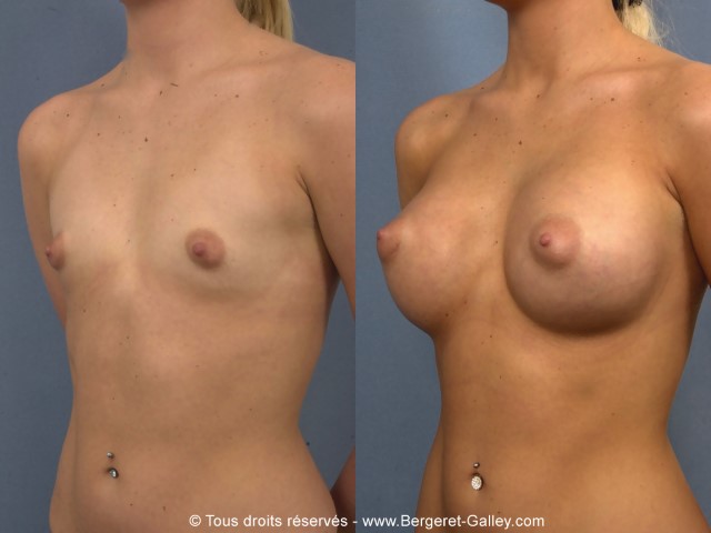 Augmentation mammaire par prothèse, cas 4, photographie avant et après