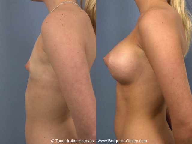 Augmentation mammaire par prothèse, cas 5, photographie avant et après