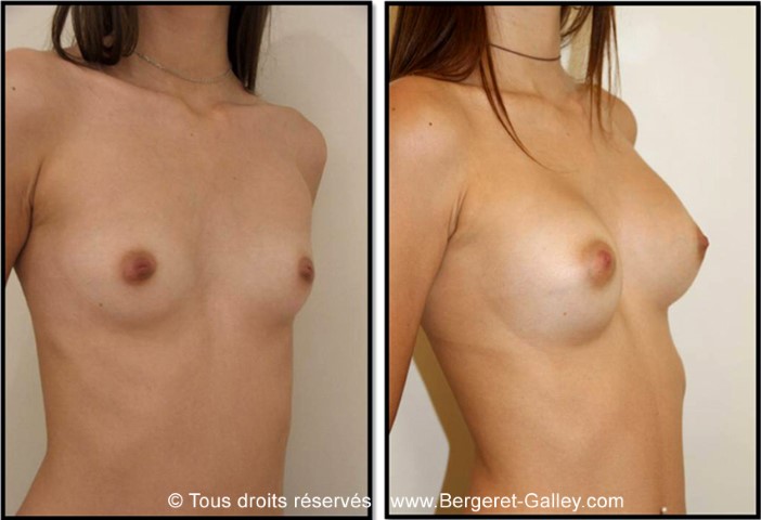 Augmentation mammaire par prothèse, cas 6, photographie avant et après