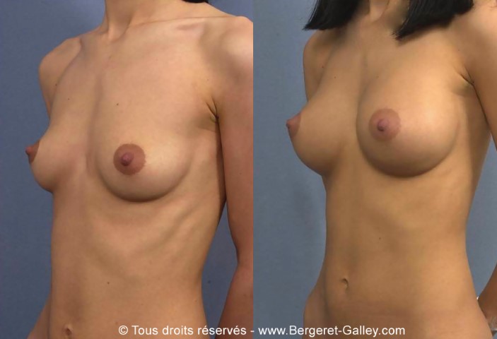 Augmentation mammaire par prothèse, cas 7, photographie avant et après