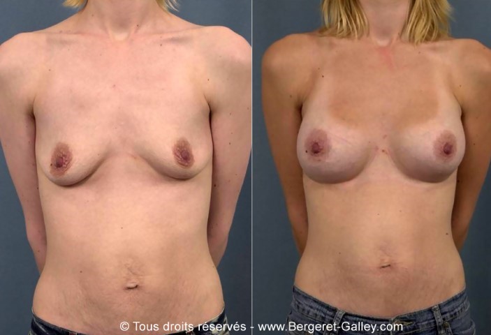 Augmentation mammaire par prothèse, cas 8, photographie avant et après