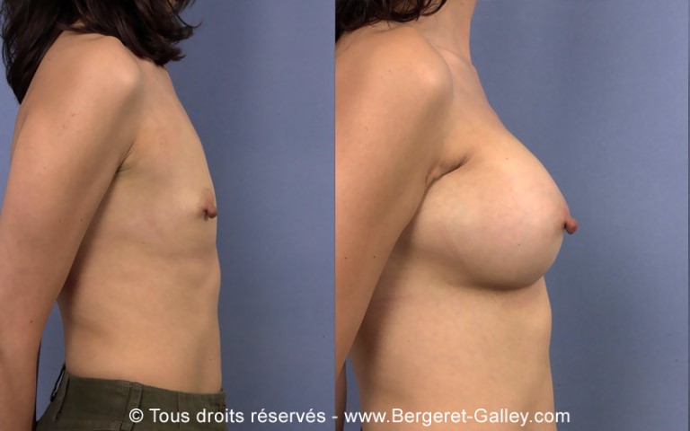 Augmentation mammaire par prothèse, cas 15, photographie avant et après