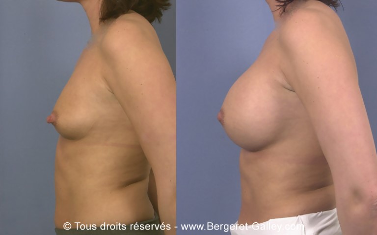Augmentation mammaire par prothèse, cas 16, photographie avant et après