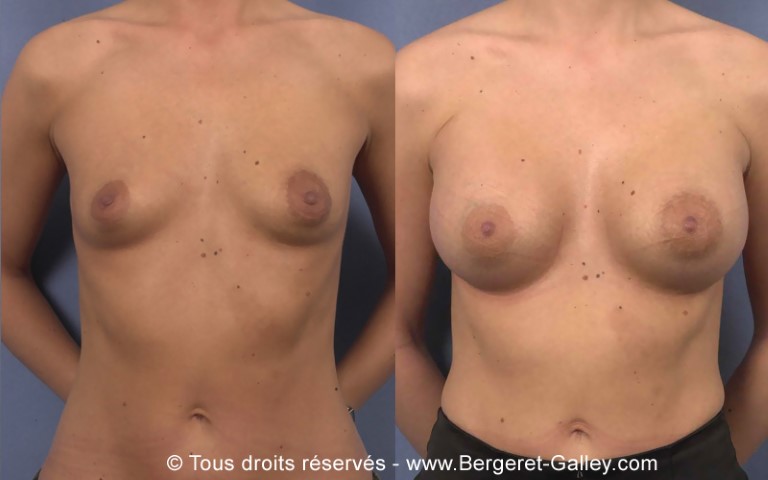 Augmentation mammaire par prothèse, cas 17, photographie avant et après