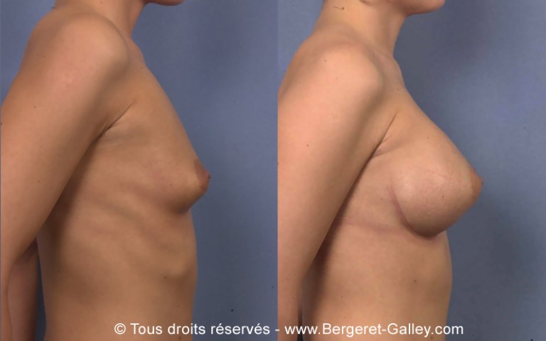 Augmentation mammaire par prothèse, cas 18, photographie avant et après