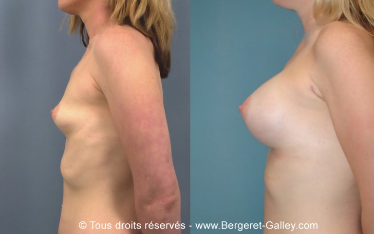 Augmentation mammaire par prothèse, cas 19, photographie avant et après