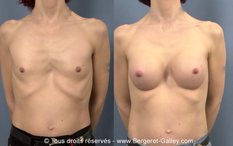 Augmentation mammaire par prothèse, cas 21, photographie avant et après