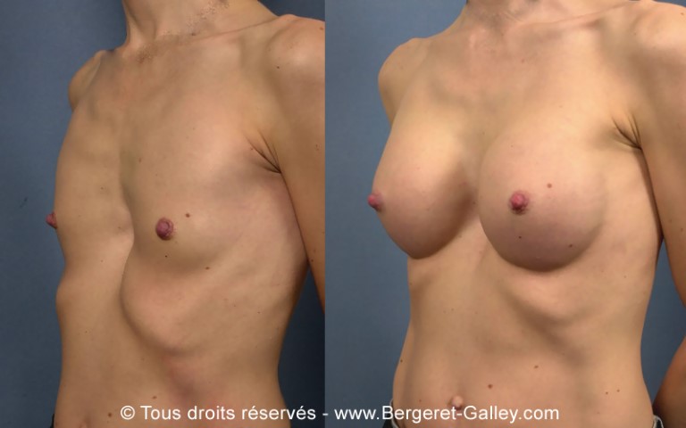 Augmentation mammaire par prothèse, cas 22, photographie avant et après