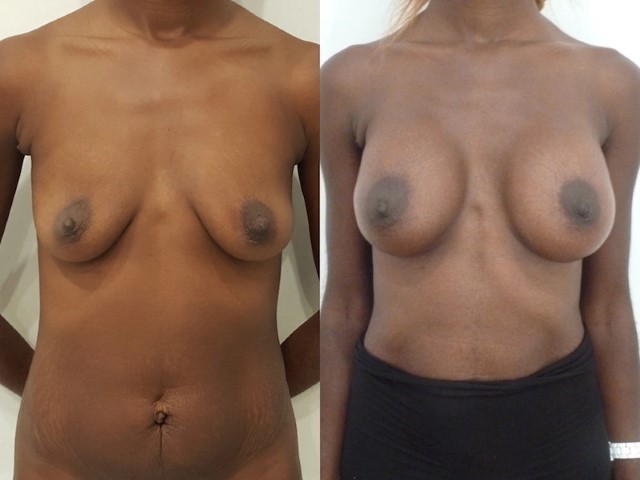 Augmentation mammaire par prothèse, cas 25, photographie avant et après