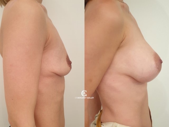 Augmentation mammaire par prothèse, cas 35, photographie avant et après