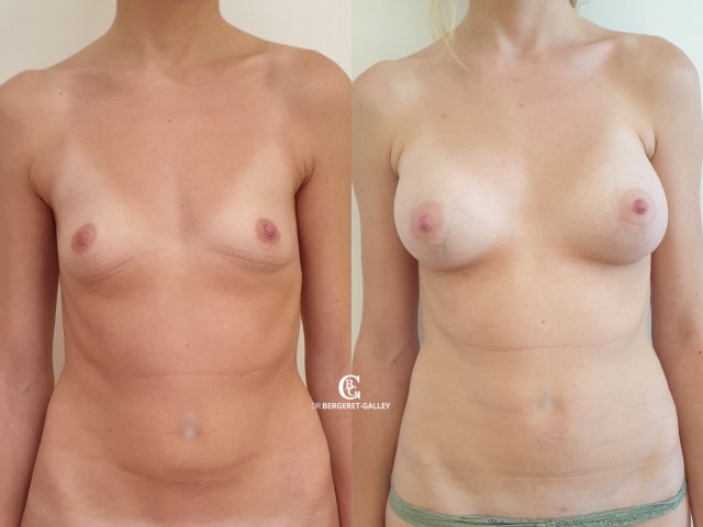 Augmentation mammaire par prothèse, cas 36, photographie avant et après