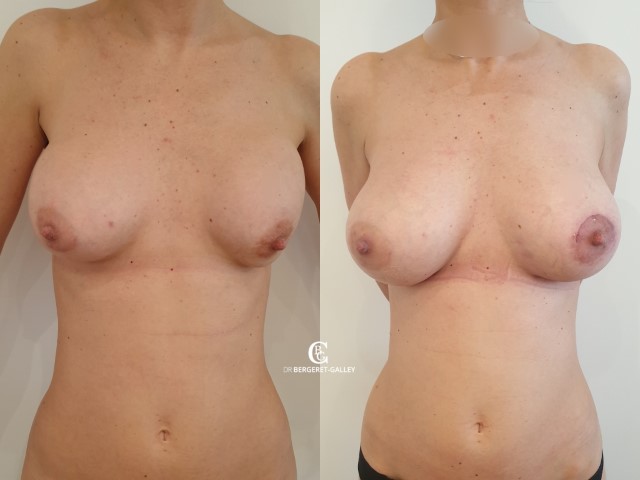Augmentation mammaire par prothèse, cas 38, photographie avant et après