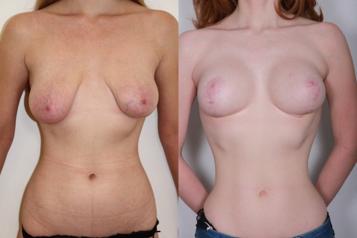 Lifting des seins, cas 5, photographie avant et après