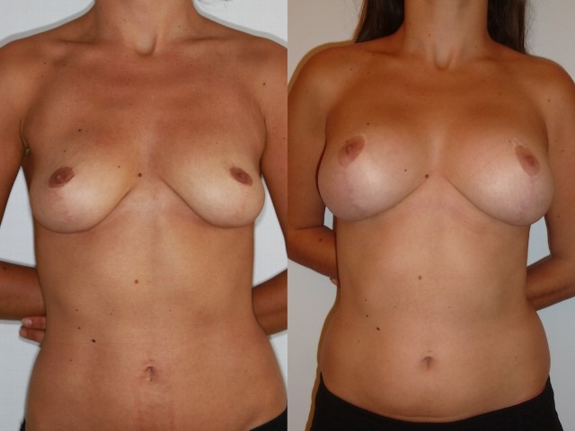 Lifting des seins, cas 6, photographie avant et après