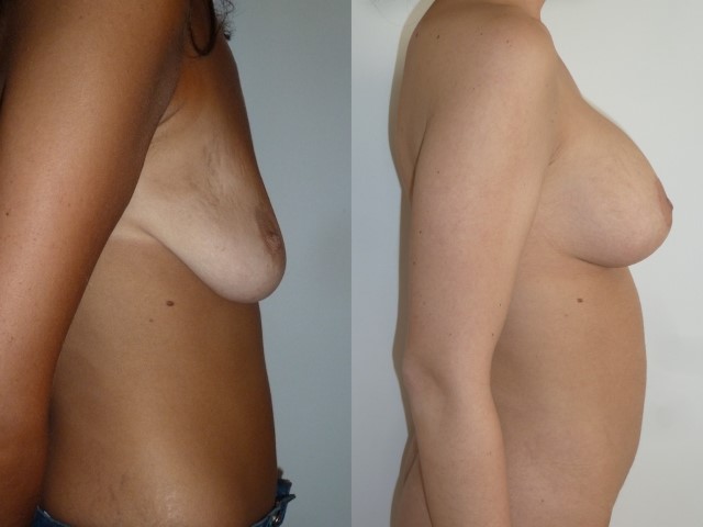 Lifting des seins, cas 8, photographie avant et après