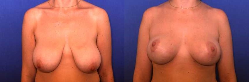 Lifting des seins, cas 9, photographie avant et après