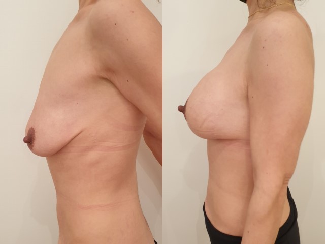 Lifting des seins, cas 11, photographie avant et après
