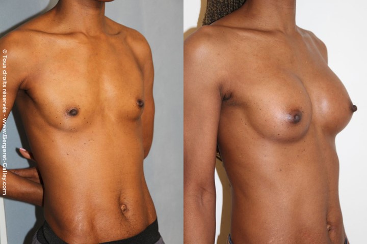 Lipofilling des seins, cas 3, photographie avant et après