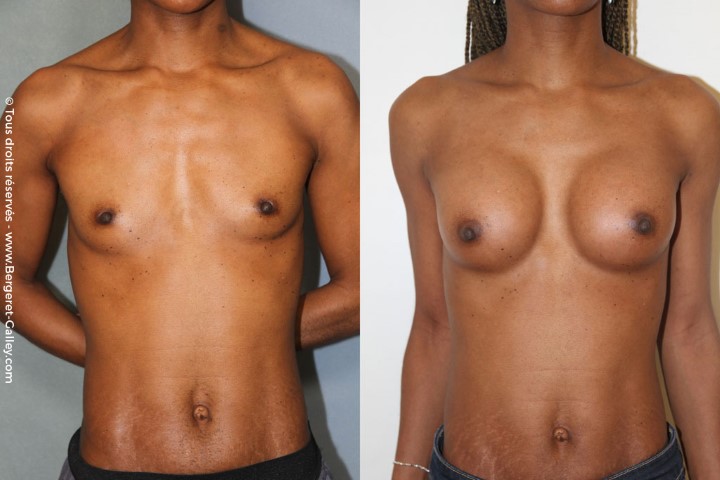 Lipofilling des seins, cas 4, photographie avant et après