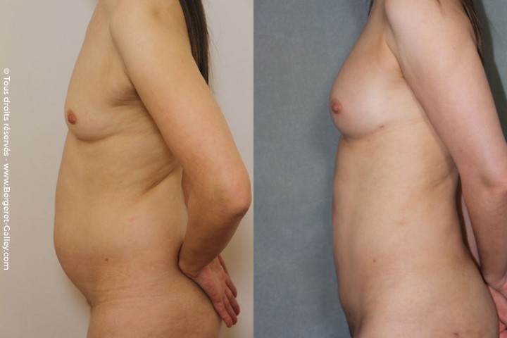Lipofilling des seins, cas 5, photographie avant et après