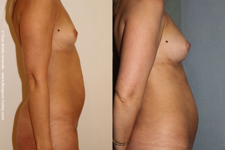 Lipofilling des seins, cas 9, photographie avant et après