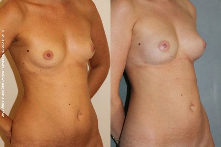 Lipofilling des seins, cas 11, photographie avant et après