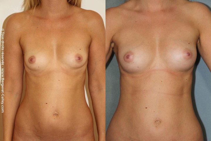 Lipofilling des seins, cas 12, photographie avant et après